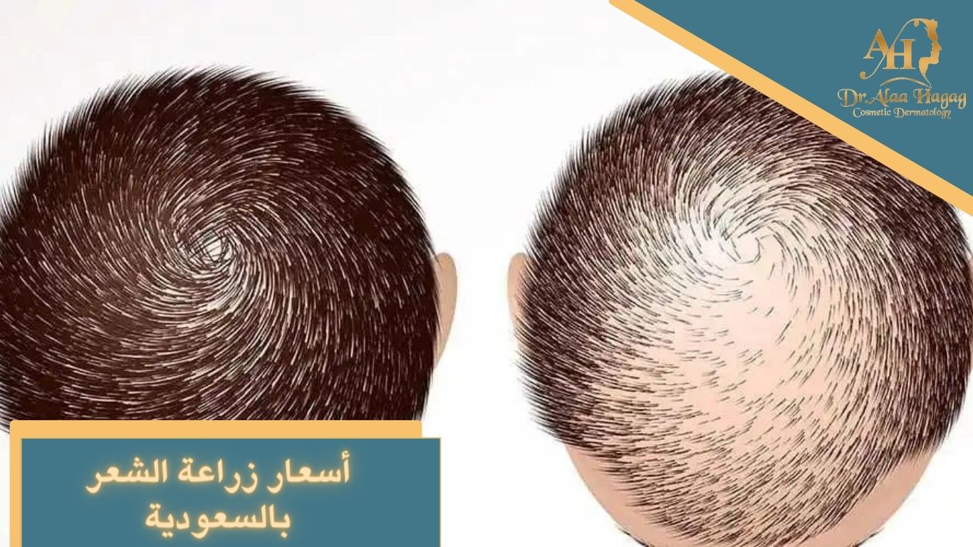 أسعار زراعة الشعر بالسعودية