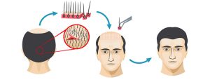 مراكز زراعة الشعر في الرياض