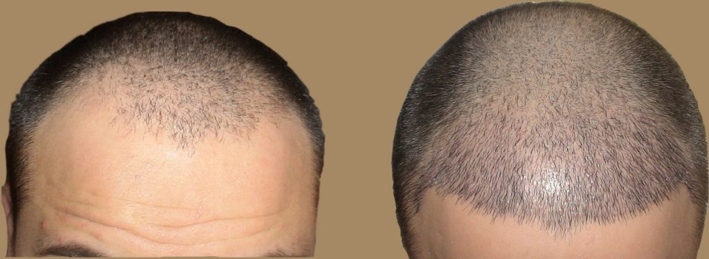 أسعار زراعة الشعر بالسعودية