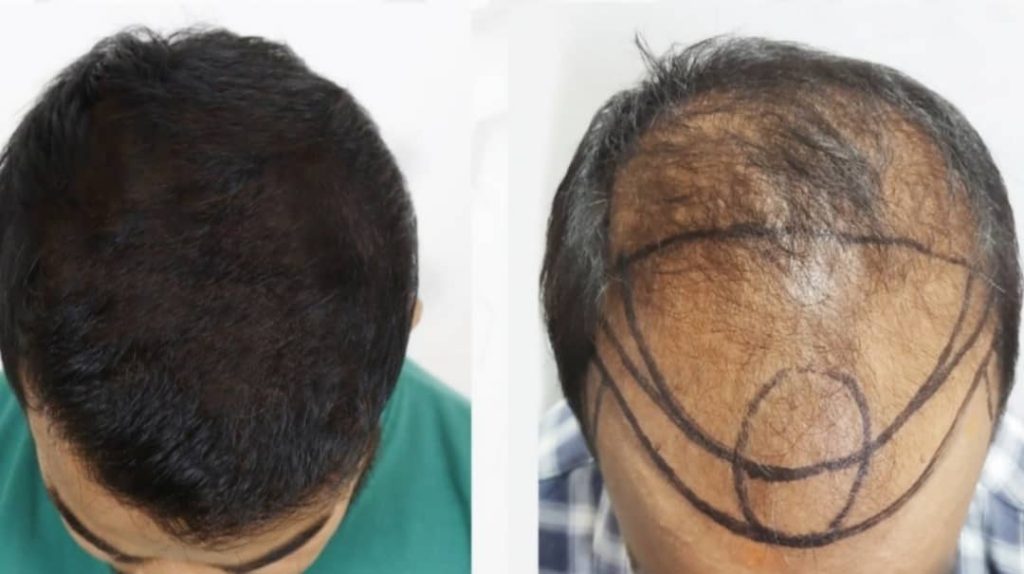 أسعار زراعة الشعر بالسعودية