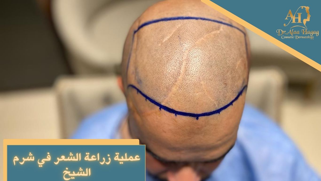 عملية زراعة الشعر في شرم الشيخ