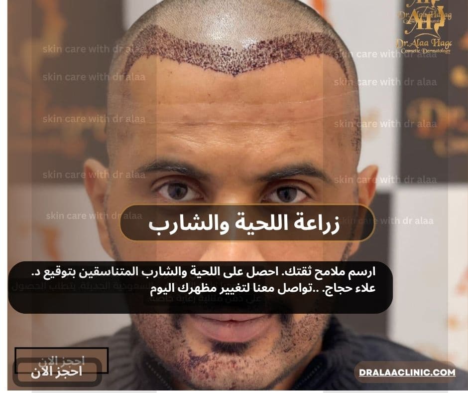 زراعة اللحية والشارب