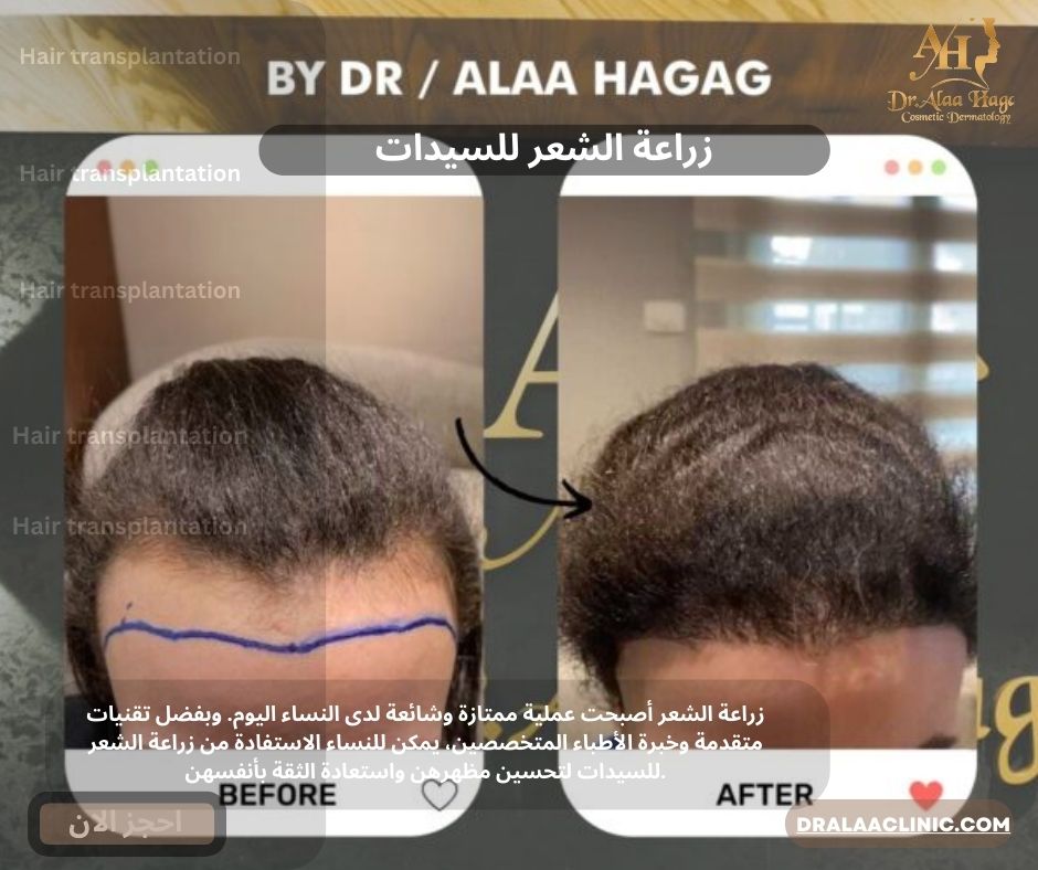 زراعة الشعر للسيدات