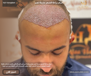 مركز زراعة الشعر مدينة نصر