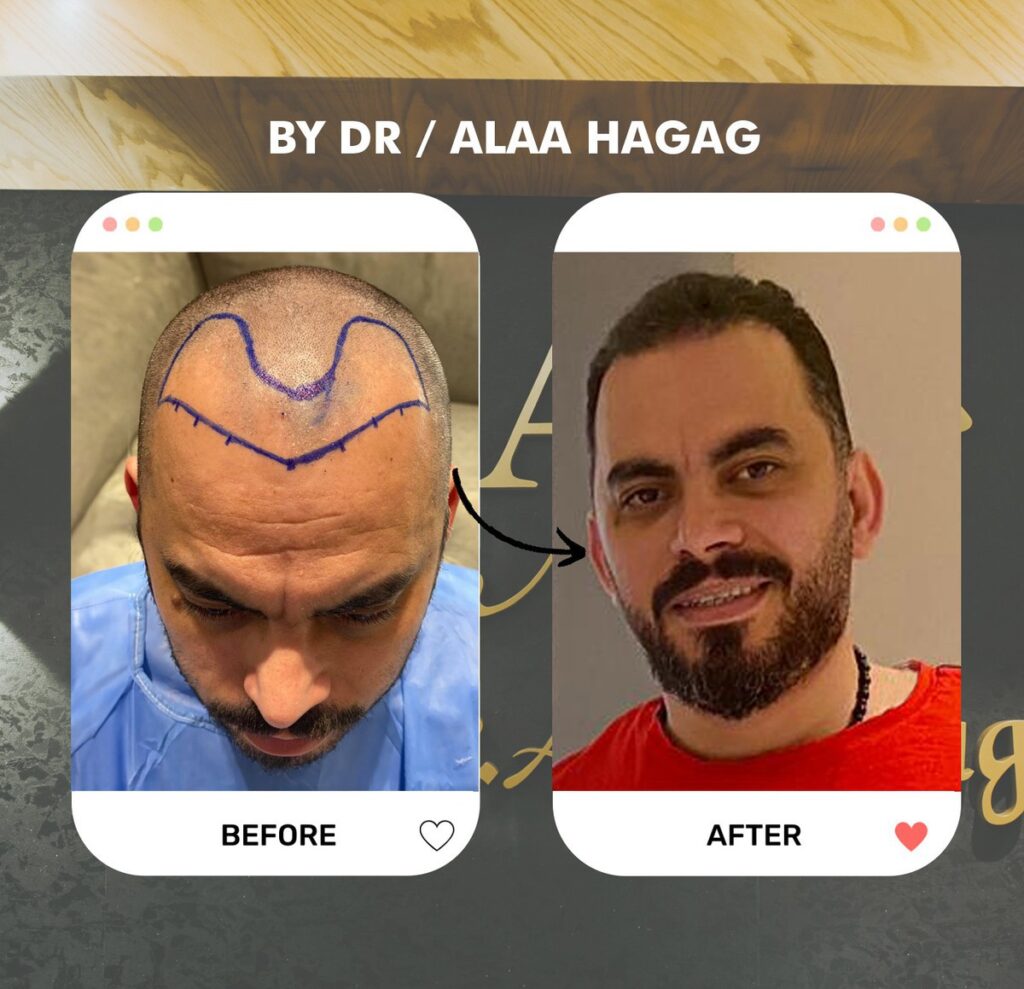 زراعة الشعر للرجال