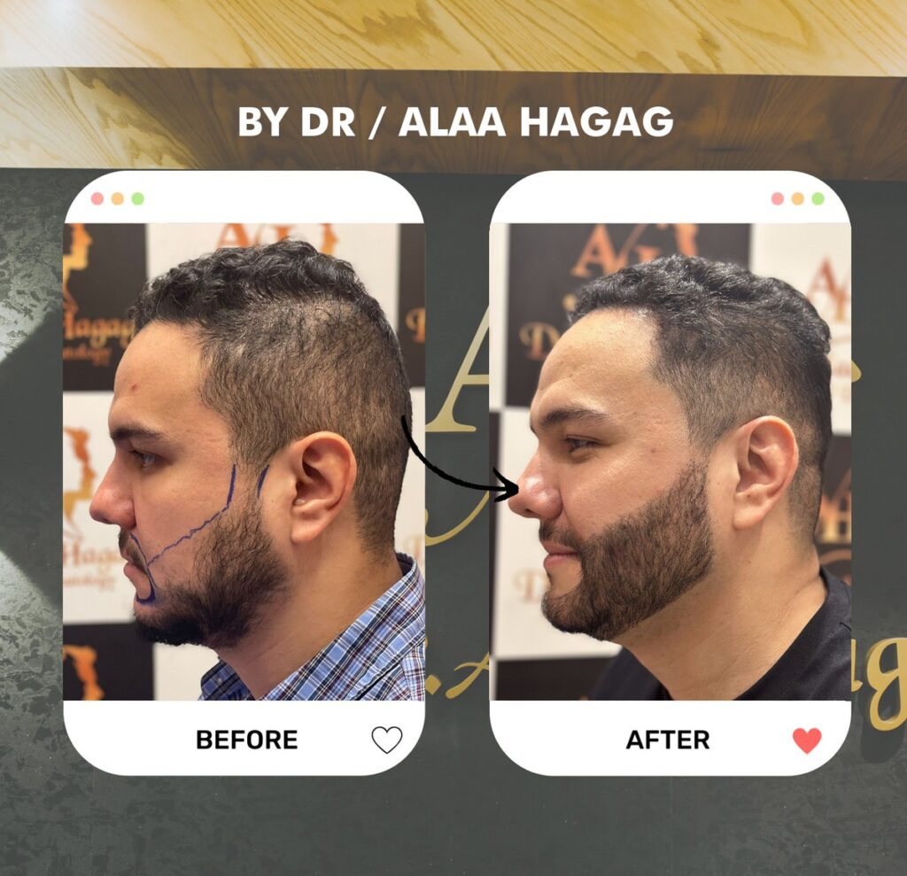 دكتور زراعة شعر في مصر