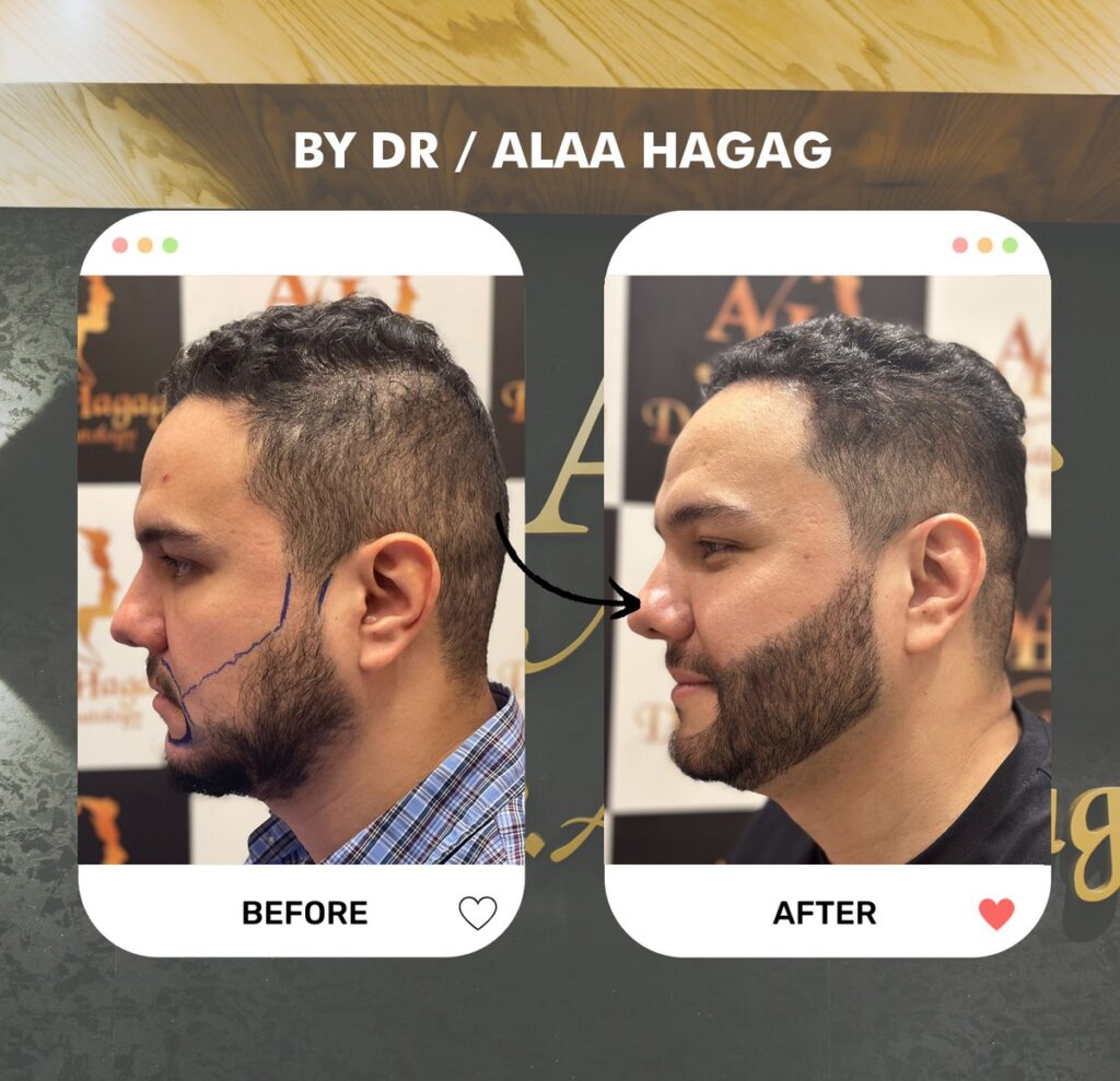 زراعة الشعر للرجال