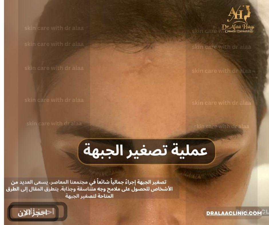 عملية تصغير الجبهة بزراعة الشعر مركز د.علاء حجاج