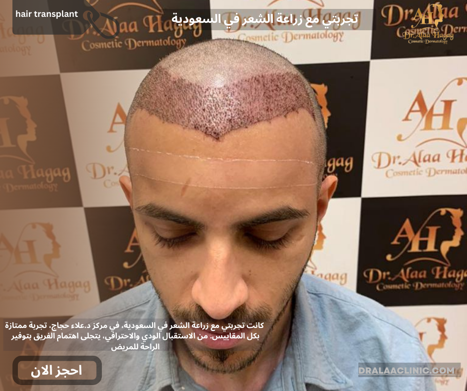 تجربتي مع زراعة الشعر في السعودية