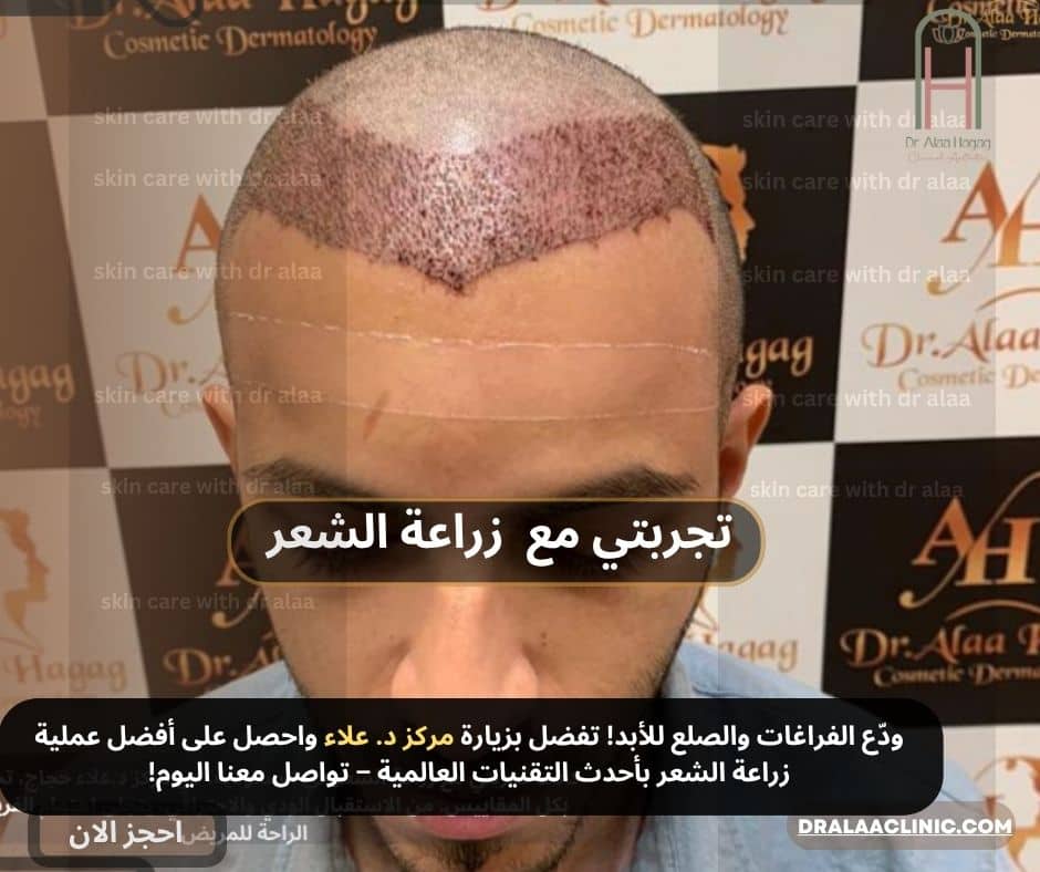 تجربتي مع زراعة الشعر