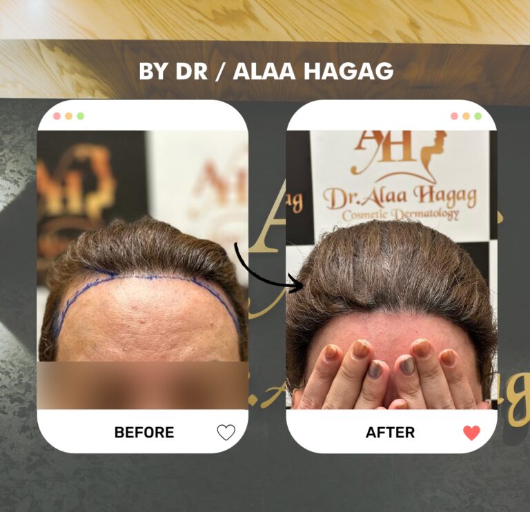 عيادات زراعة الشعر في التجمع