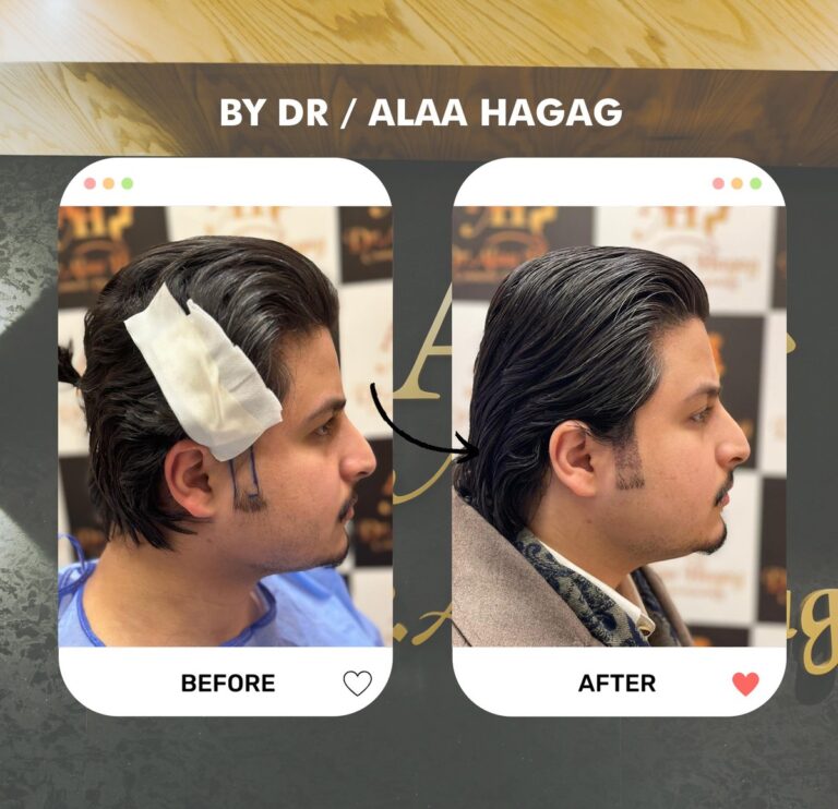 زراعة الشعر بطريقة الاقتطاف