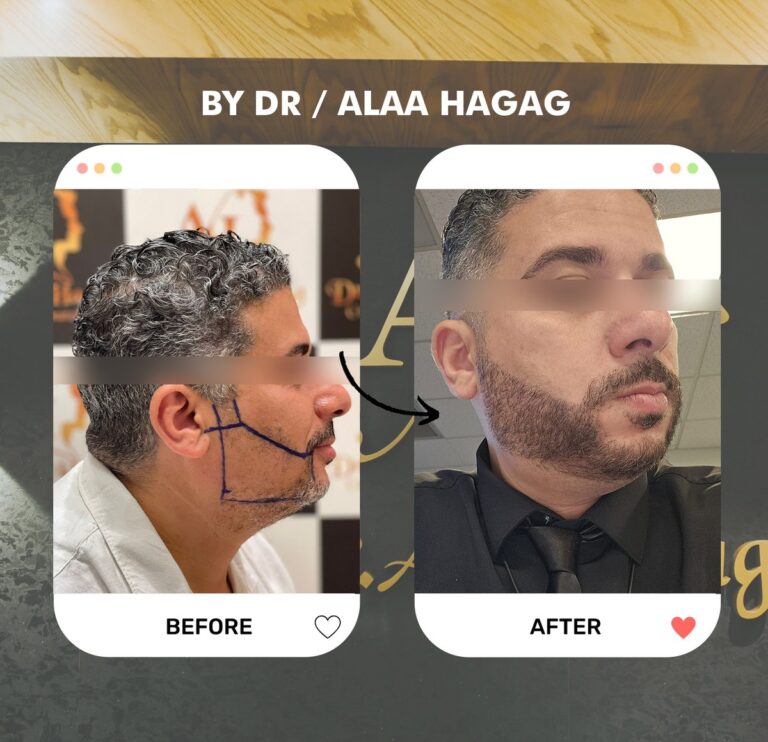 زراعة الشعر بطريقة الاقتطاف