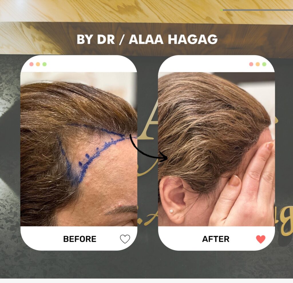 عيادات زراعة الشعر في التجمع