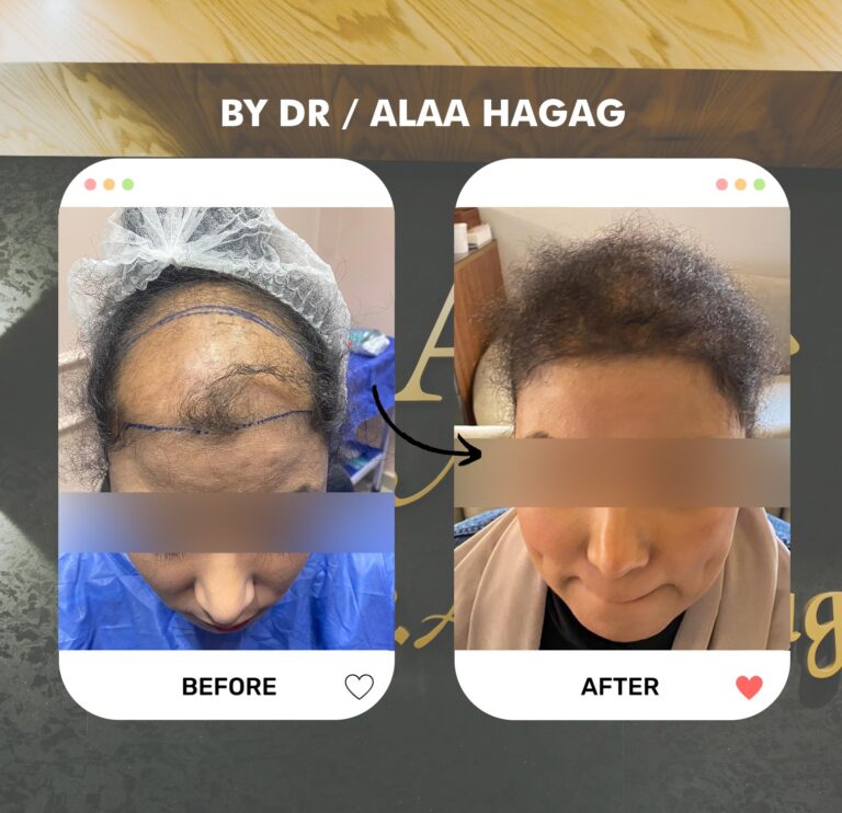 زراعة الشعر بطريقة الاقتطاف