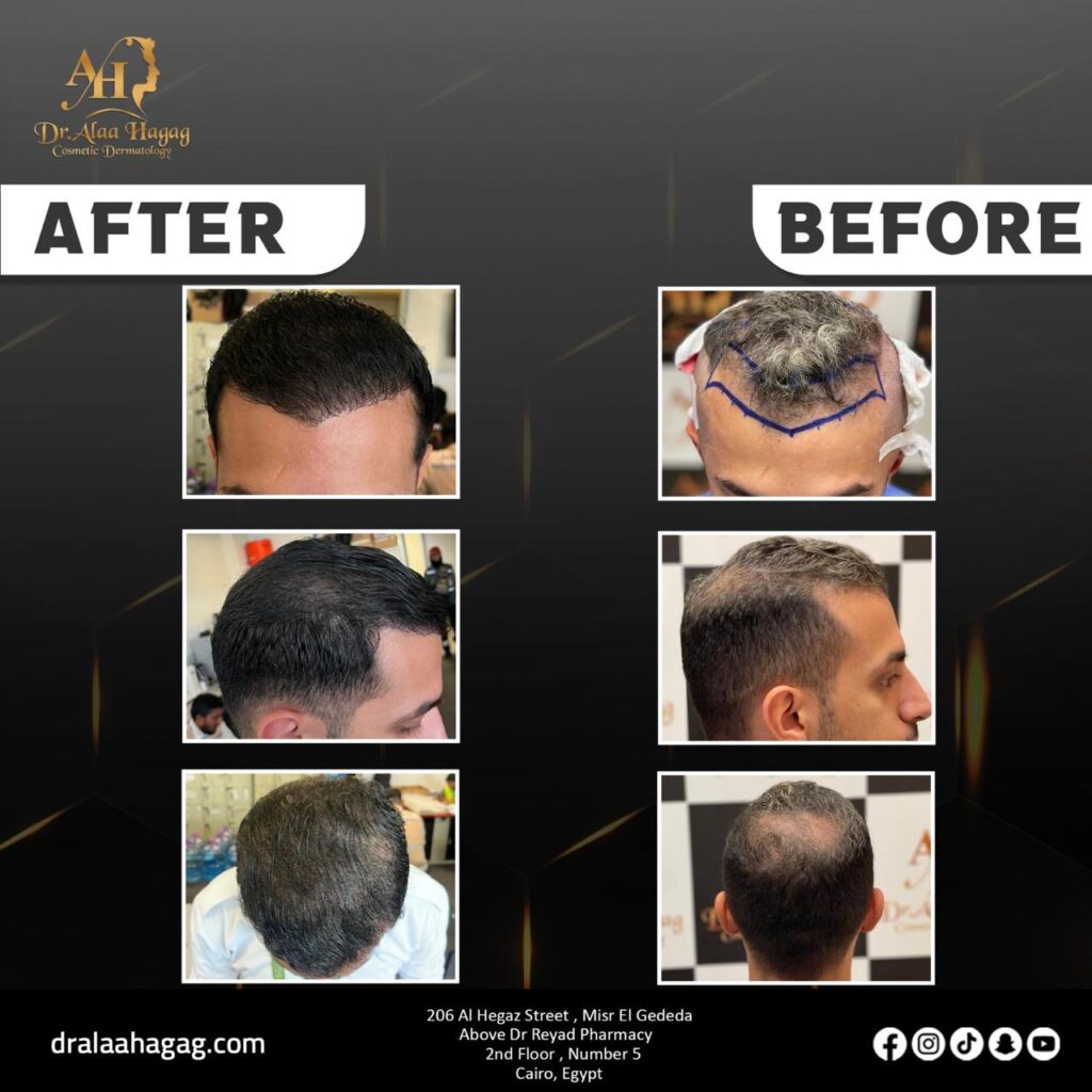 زراعة الشعر بتقنية dhi