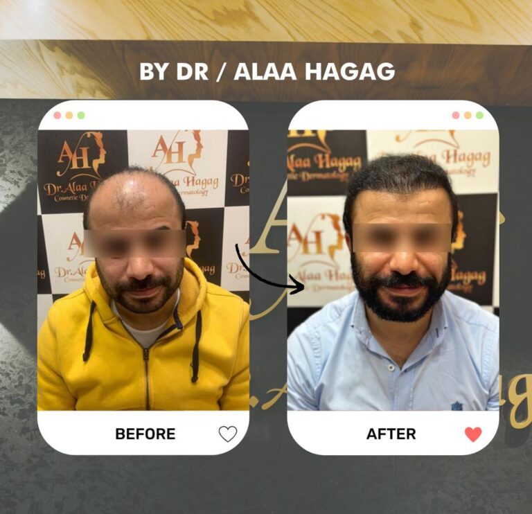 زراعة الشعر بطريقة الاقتطاف