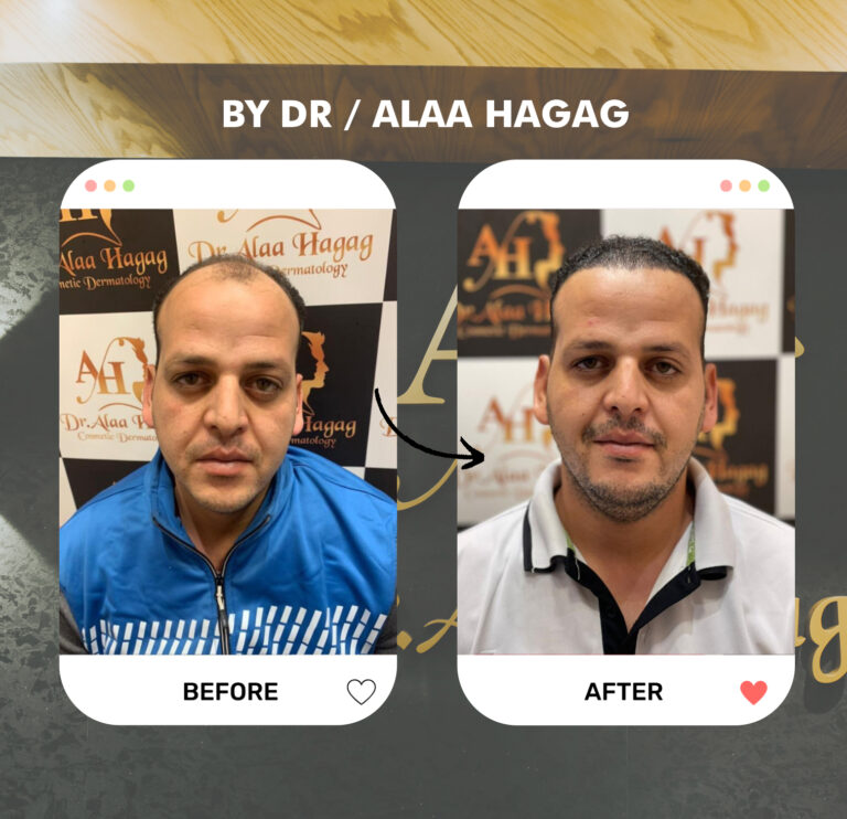 طريقة زراعة الشعر