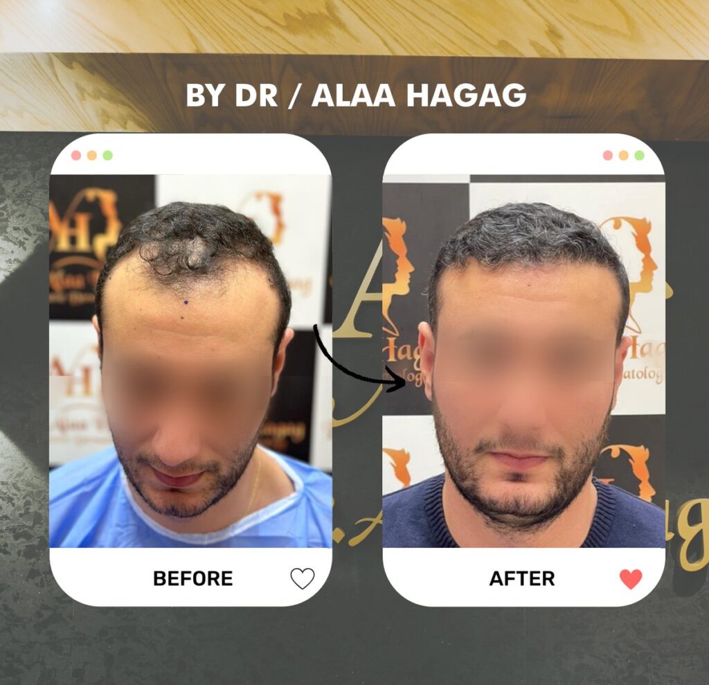 زراعة الشعر بالرياض