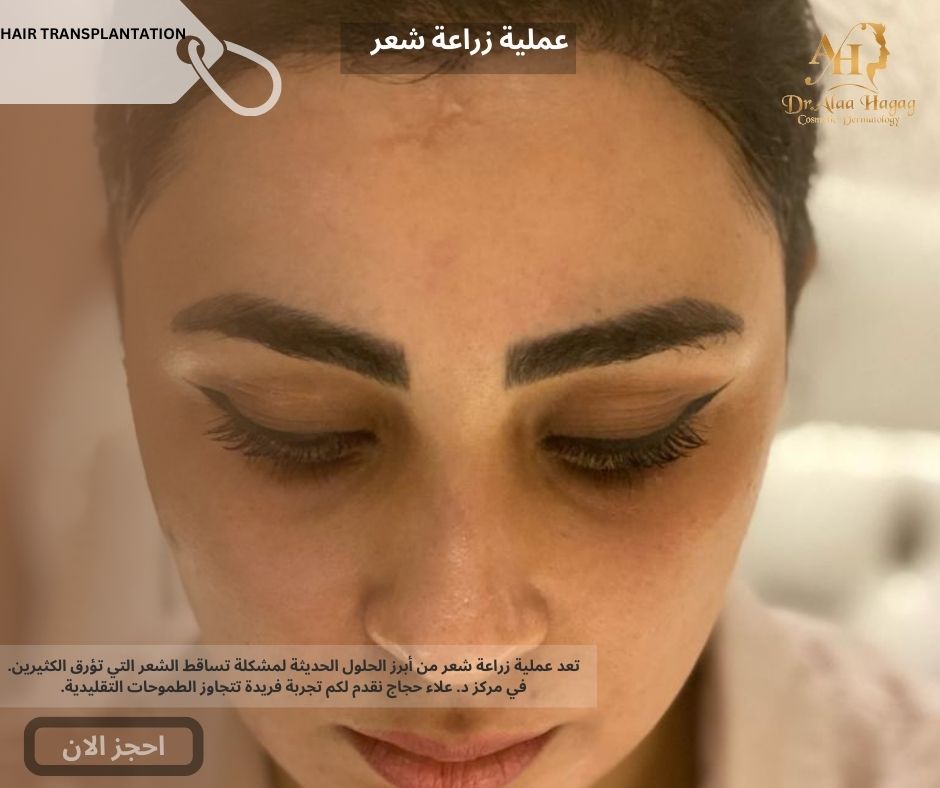 عملية زراعة شعر