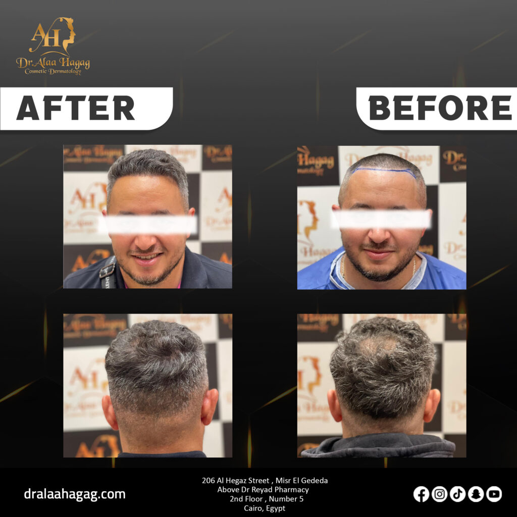 زراعة الشعر بالرياض