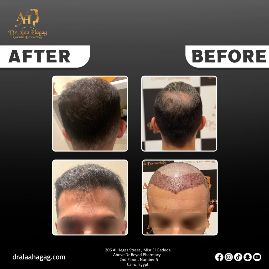 زراعة الشعر بالرياض