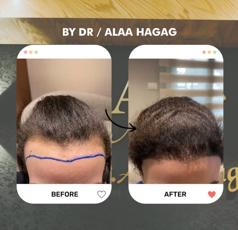 عملية زراعة شعر