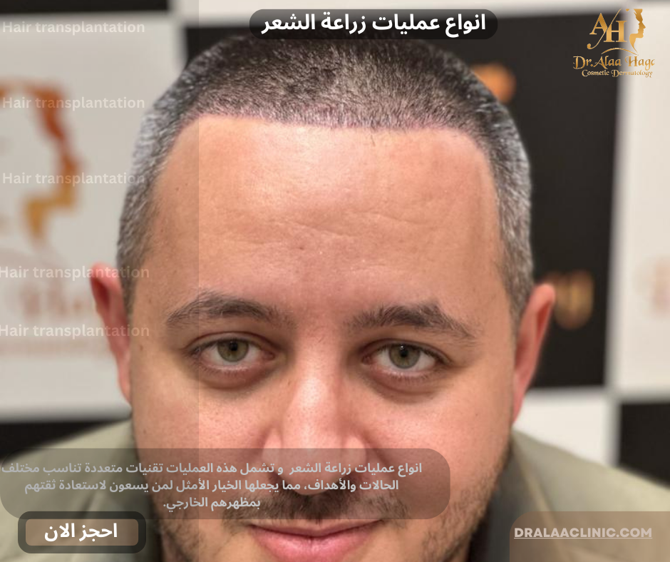 انواع عمليات زراعة الشعر