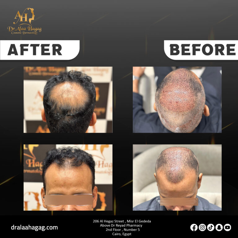 اكتشف أحدث تقنية في زراعة الشعر