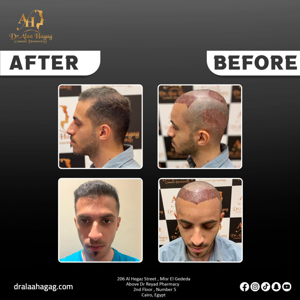 خطوات عملية زراعة الشعر