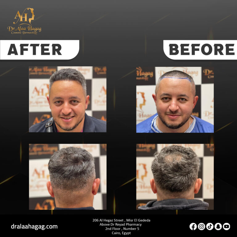 زراعة الشعر في السعودية جدة