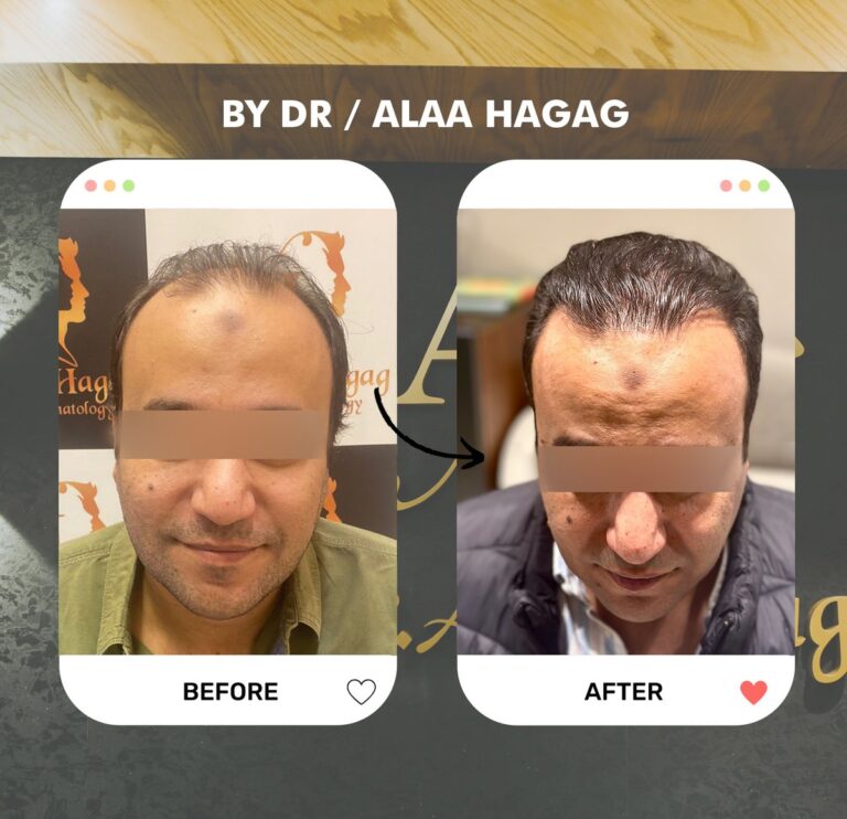 انواع عمليات زراعة الشعر