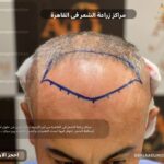 مراكز زراعة الشعر فى القاهرة