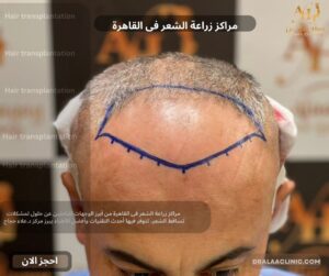 مراكز زراعة الشعر فى القاهرة