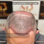 افضل عيادات زراعة الشعر في مصر