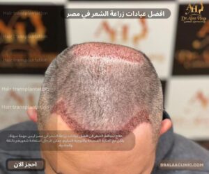 افضل عيادات زراعة الشعر في مصر