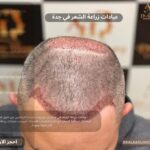 عيادات زراعة الشعر في جدة