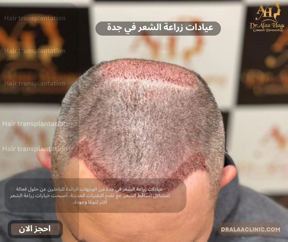 عيادات زراعة الشعر في جدة