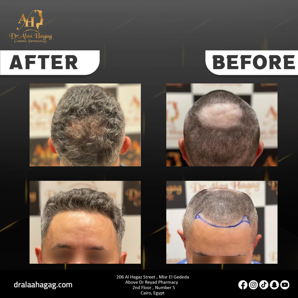 علاج فراغات الشعر بالزراعة