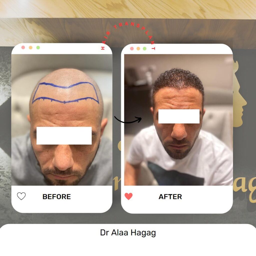 تكاليف زراعة الشعر في السعودية