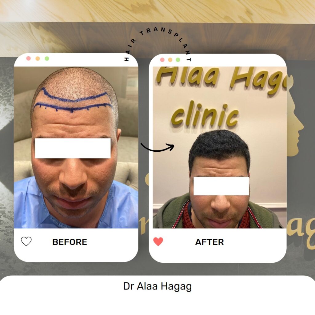 حل مشكلة تساقط الشعر