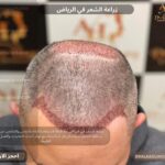 زراعة الشعر في الرياض