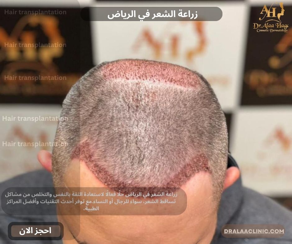 زراعة الشعر في الرياض