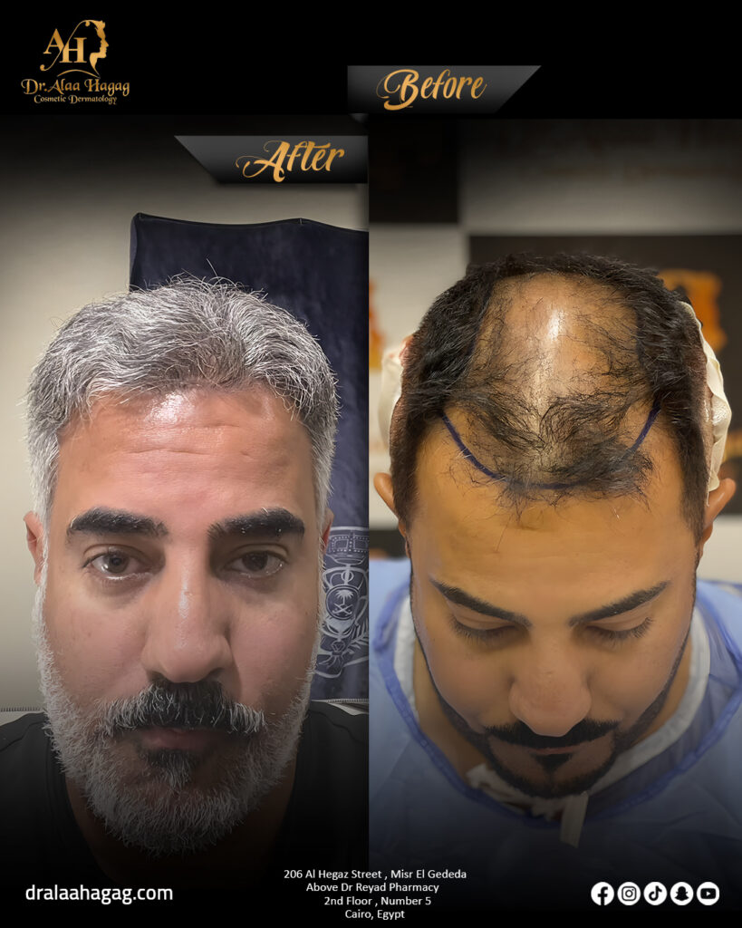 زراعة الشعر بالاقتطاف