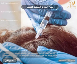 حقن الخلايا الجذعية للشعر