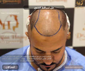 حل تساقط الشعر