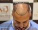 حل تساقط الشعر