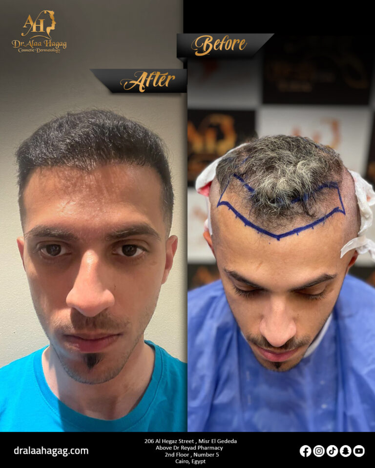زراعة الشنب