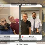 علامات الصلع الوراثي