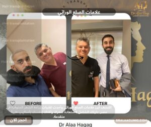 علامات الصلع الوراثي